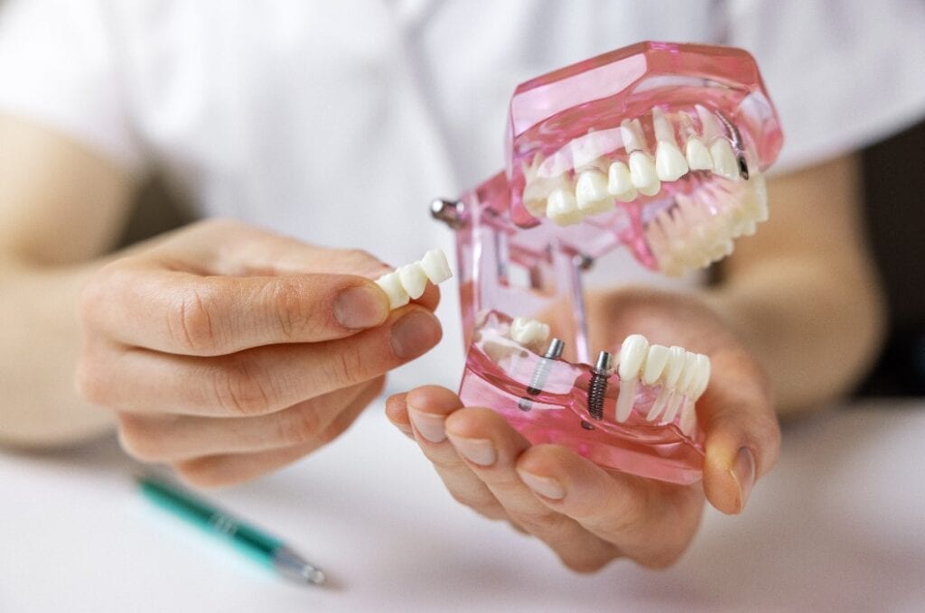 Zahnarzt Implantologe zeigt Zahnbrücke Implantat-Technologie